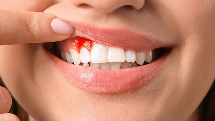 Douleur ou saignement des gencives : faut-il courir chez le dentiste ?